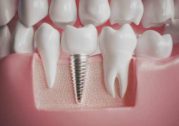 Implantes dentales en Ruzafa