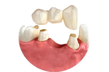 Prótesis dentales en Valencia